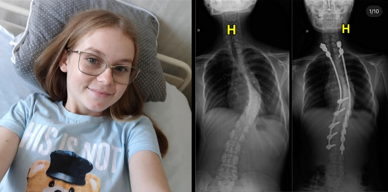 Pediatric Scoliosis