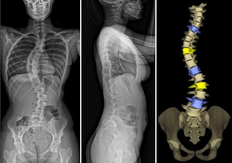 eos-imaging-scoliosis-2d-anteroposterior-lateral-views-3d-anteroposterior-view
